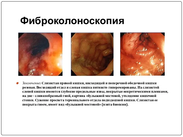 Фиброколоноскопия Заключение: Слизистая прямой кишки, нисходящей и поперечной ободочной кишки