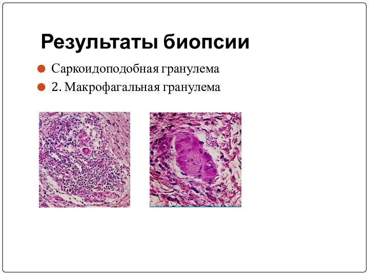 Результаты биопсии Саркоидоподобная гранулема 2. Макрофагальная гранулема