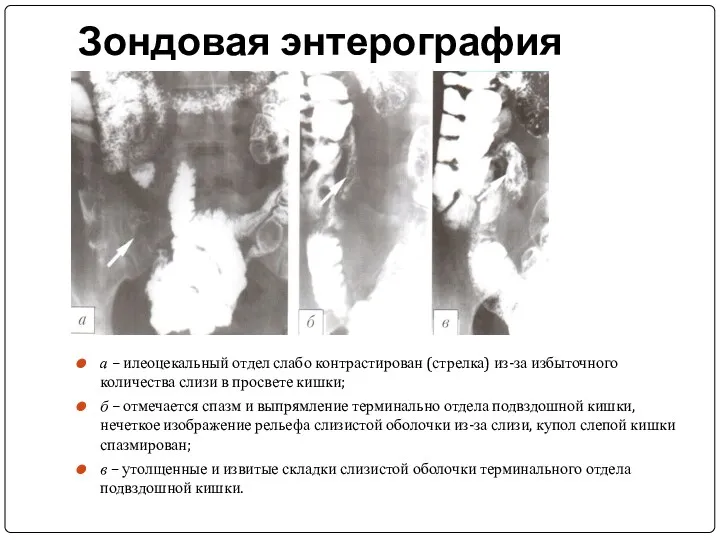 Зондовая энтерография а – илеоцекальный отдел слабо контрастирован (стрелка) из-за