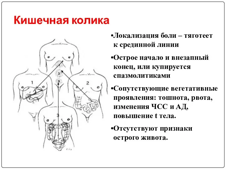 Кишечная колика Локализация боли – тяготеет к срединной линии Острое