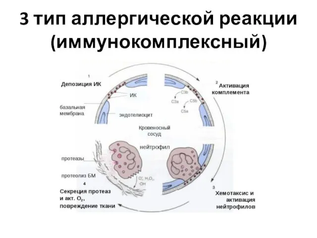 3 тип аллергической реакции (иммунокомплексный)