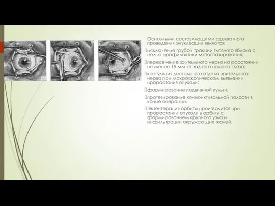 Основными составляющими адекватного проведения энуклеации являются: исключение грубой тракции глазного