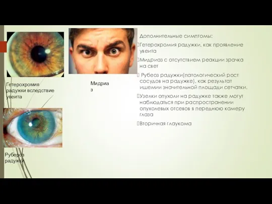 Дополнительные симптомы: Гетерохромия радужки, как проявление увеита Мидриаз с отсутствием