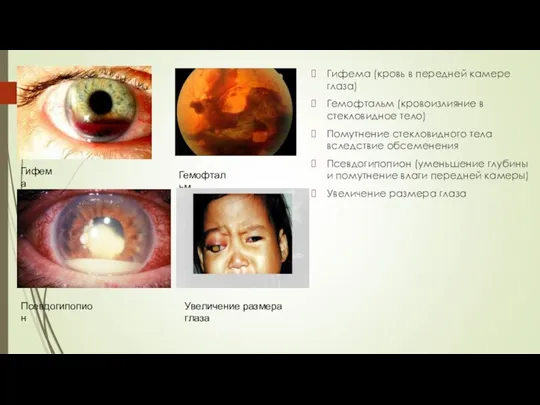 Гифема (кровь в передней камере глаза) Гемофтальм (кровоизлияние в стекловидное