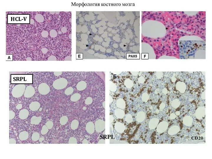 HCL-V SRPL Морфология костного мозга