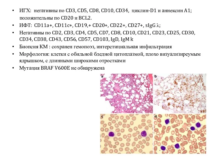 ИГХ: негативны по CD3, CD5, CD8, CD10, CD34, циклин-D1 и