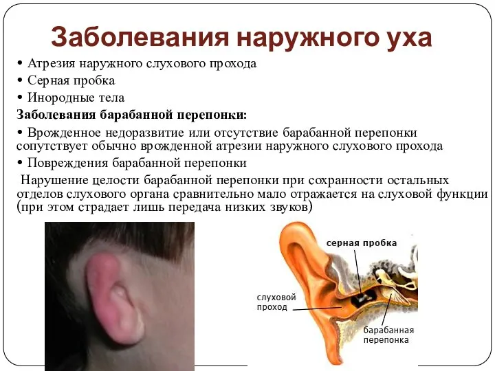 Заболевания наружного уха • Атрезия наружного слухового прохода • Серная