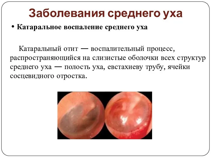 Заболевания среднего уха • Катаральное воспаление среднего уха Катаральный отит