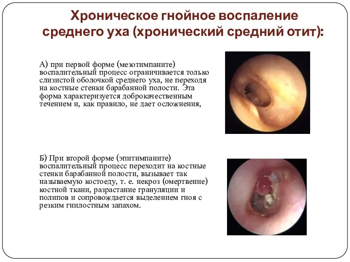 Хроническое гнойное воспаление среднего уха (хронический средний отит): А) при