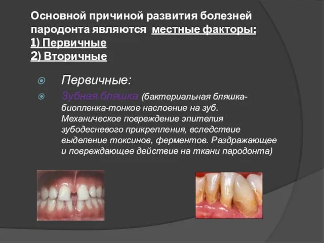 Основной причиной развития болезней пародонта являются местные факторы: 1) Первичные