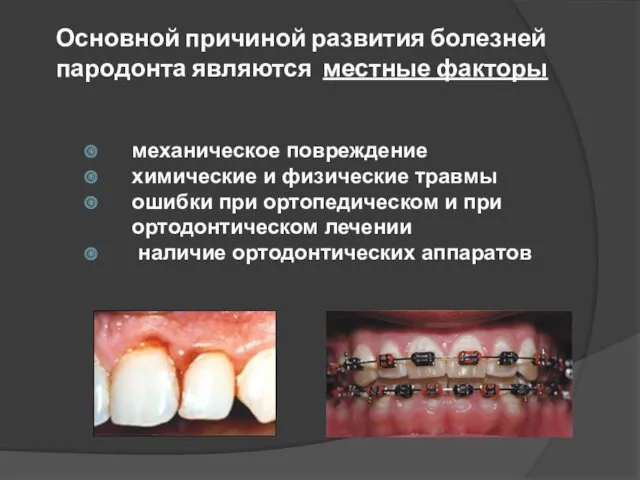 Основной причиной развития болезней пародонта являются местные факторы механическое повреждение