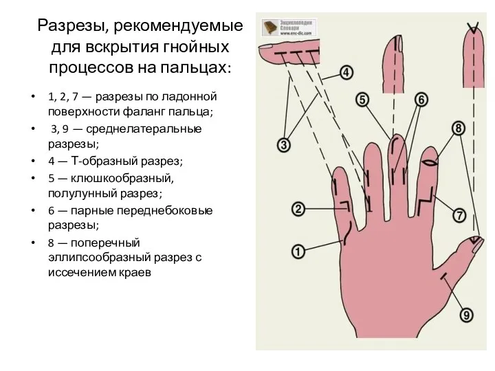 Разрезы, рекомендуемые для вскрытия гнойных процессов на пальцах: 1, 2, 7 — разрезы