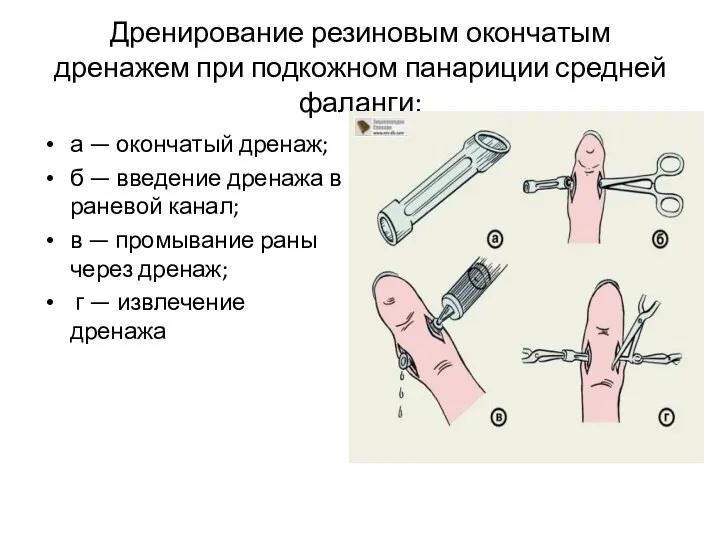 Дренирование резиновым окончатым дренажем при подкожном панариции средней фаланги: а — окончатый дренаж;