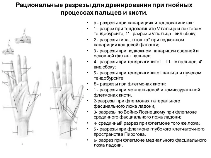 Рациональные разрезы для дренирования при гнойных процессах пальцев и кисти. а - разрезы