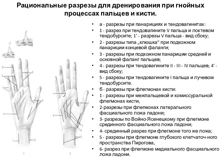 Рациональные разрезы для дренирования при гнойных процессах пальцев и кисти.