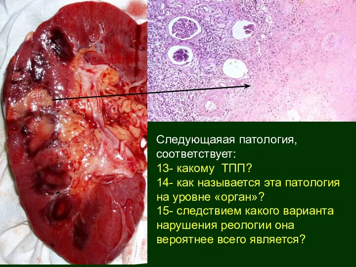 Следующаяая патология, соответствует: 13- какому ТПП? 14- как называется эта