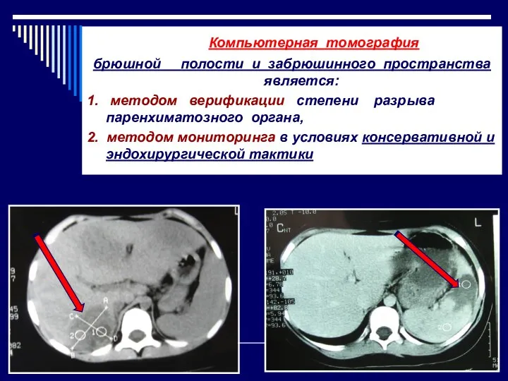 Компьютерная томография брюшной полости и забрюшинного пространства является: 1. методом