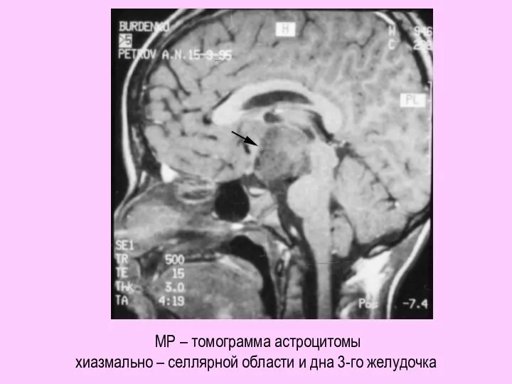 МР – томограмма астроцитомы хиазмально – селлярной области и дна 3-го желудочка