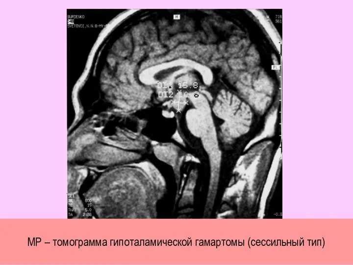 МР – томограмма гипоталамической гамартомы (сессильный тип)
