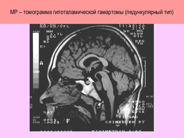 МР – томограмма гипоталамической гамартомы (педункулярный тип)