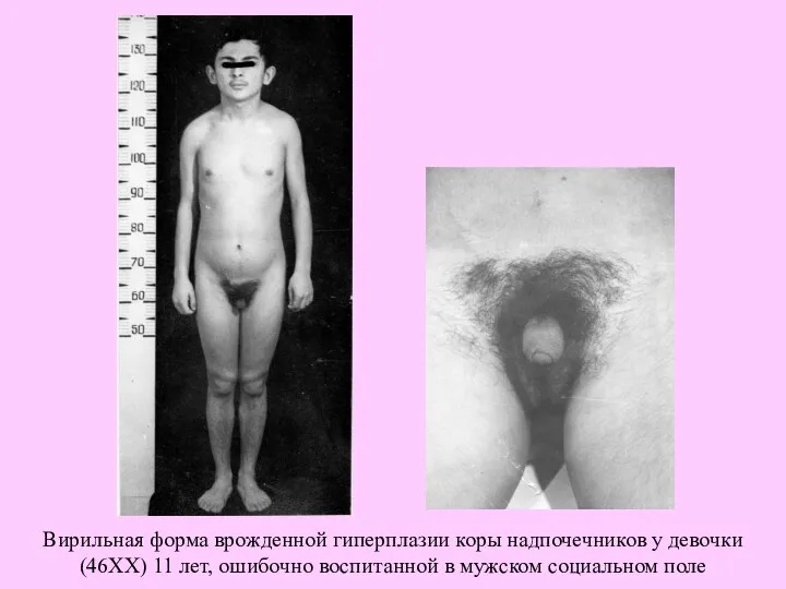 Вирильная форма врожденной гиперплазии коры надпочечников у девочки (46XX) 11 лет, ошибочно воспитанной