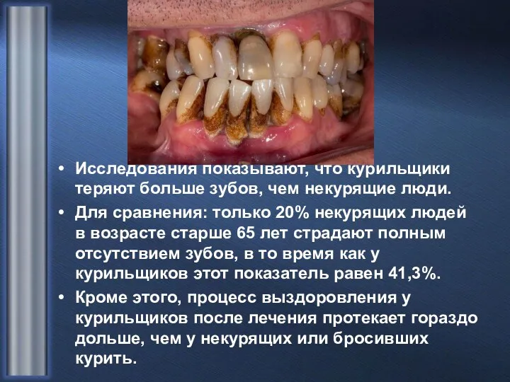 Исследования показывают, что курильщики теряют больше зубов, чем некурящие люди.