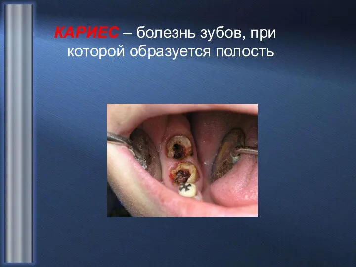 КАРИЕС – болезнь зубов, при которой образуется полость