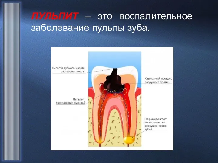 ПУЛЬПИТ – это воспалительное заболевание пульпы зуба.