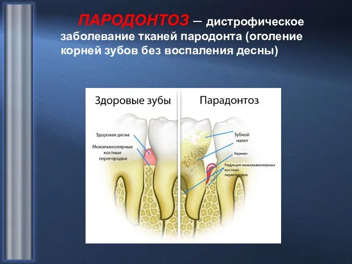 ПАРОДОНТОЗ – дистрофическое заболевание тканей пародонта (оголение корней зубов без воспаления десны)