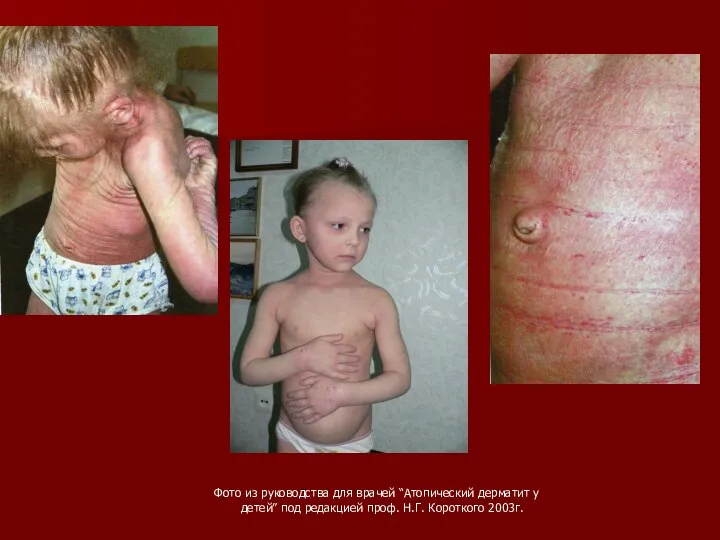 Фото из руководства для врачей “Атопический дерматит у детей” под редакцией проф. Н.Г. Короткого 2003г.
