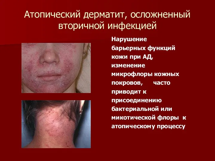 Атопический дерматит, осложненный вторичной инфекцией Нарушение барьерных функций кожи при