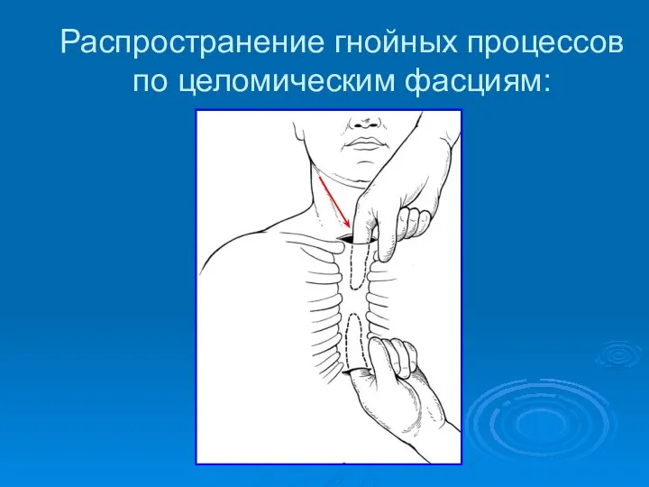 Распространение гнойных процессов по целомическим фасциям: