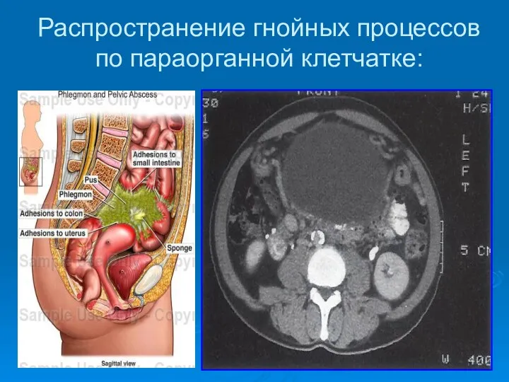 Распространение гнойных процессов по параорганной клетчатке: