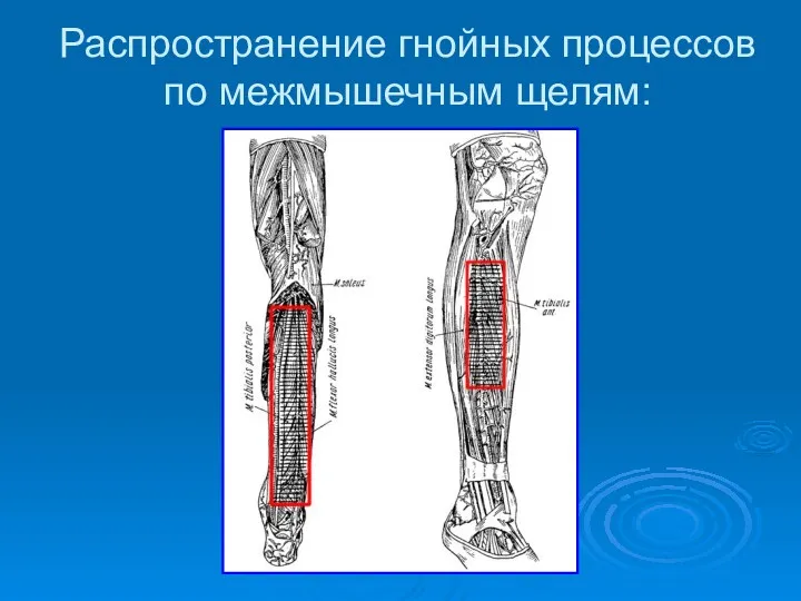 Распространение гнойных процессов по межмышечным щелям: