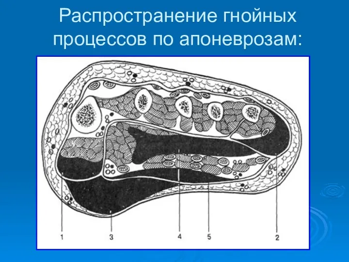 Распространение гнойных процессов по апоневрозам: