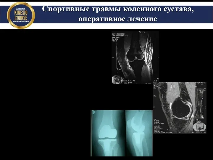 Спортивные травмы коленного сустава, оперативное лечение Резекция мениска Реконструкция ПКС