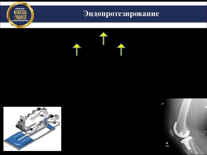 Эндопротезирование 1990-2000 за декаду 95% у лиц 40-49 лет Задачи: