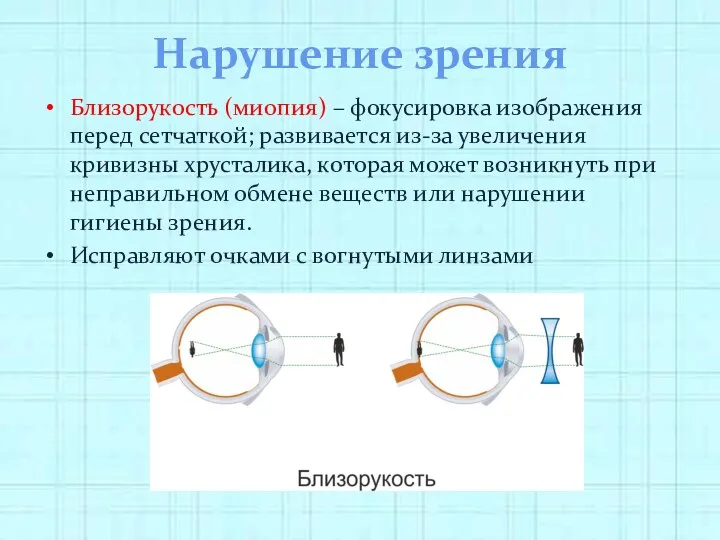 Нарушение зрения Близорукость (миопия) – фокусировка изображения перед сетчаткой; развивается