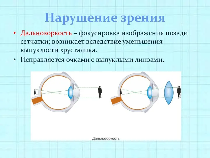 Нарушение зрения Дальнозоркость – фокусировка изображения позади сетчатки; возникает вследствие