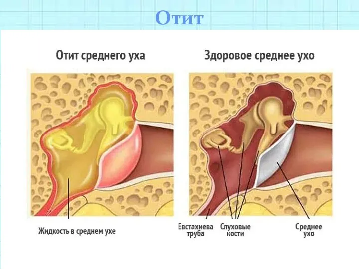 Отит