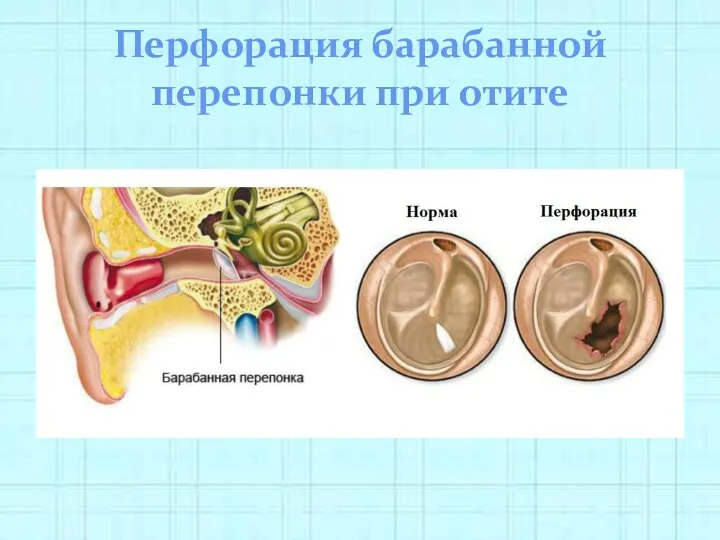 Перфорация барабанной перепонки при отите