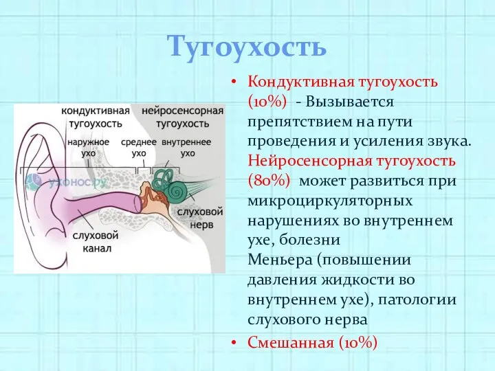 Тугоухость Кондуктивная тугоухость (10%) - Вызывается препятствием на пути проведения