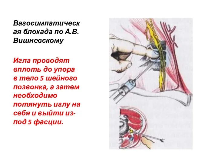Вагосимпатическая блокада по А.В.Вишневскому Игла проводят вплоть до упора в