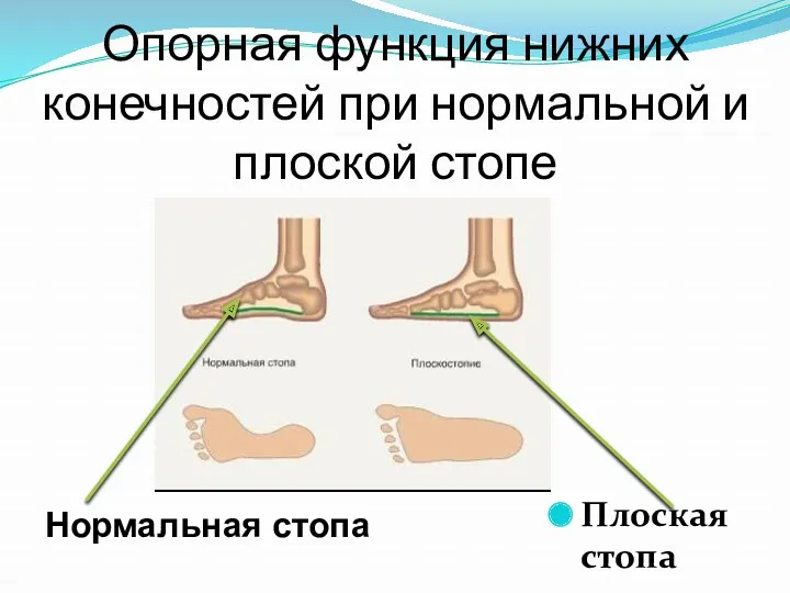 Опорная функция нижних конечностей при нормальной и плоской стопе Плоская стопа Нормальная стопа