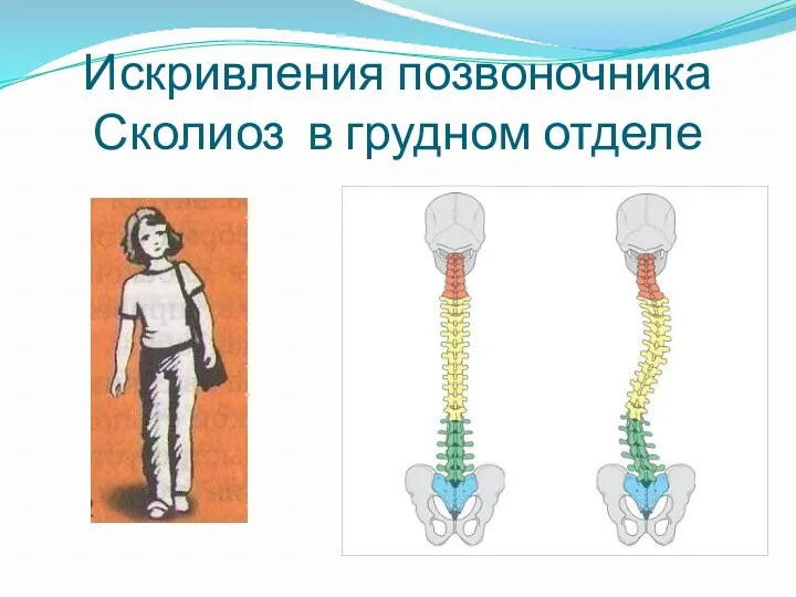 Искривления позвоночника Сколиоз в грудном отделе