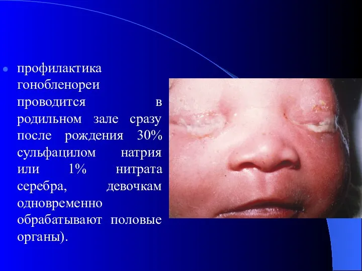 профилактика гонобленореи проводится в родильном зале сразу после рождения 30%