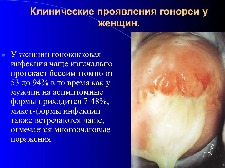 Клинические проявления гонореи у женщин. У женщин гонококковая инфекция чаще