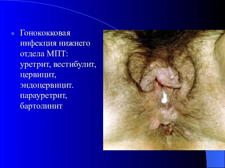 Гонококковая инфекция нижнего отдела МПТ: уретрит, вестибулит, цервицит, эндоцервицит. парауретрит, бартолинит