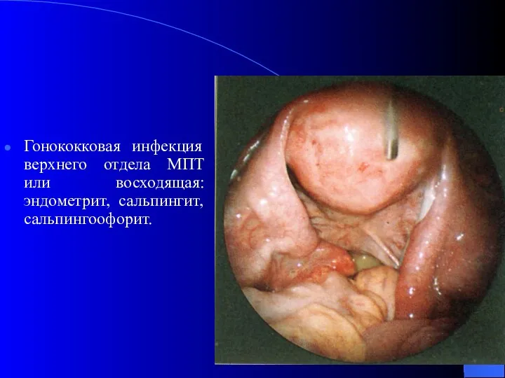 Гонококковая инфекция верхнего отдела МПТ или восходящая: эндометрит, сальпингит, сальпингоофорит.