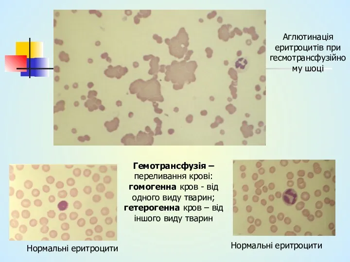 Аглютинація еритроцитів при гесмотрансфузійному шоці Нормальні еритроцити Гемотрансфузія – переливання крові: гомогенна кров